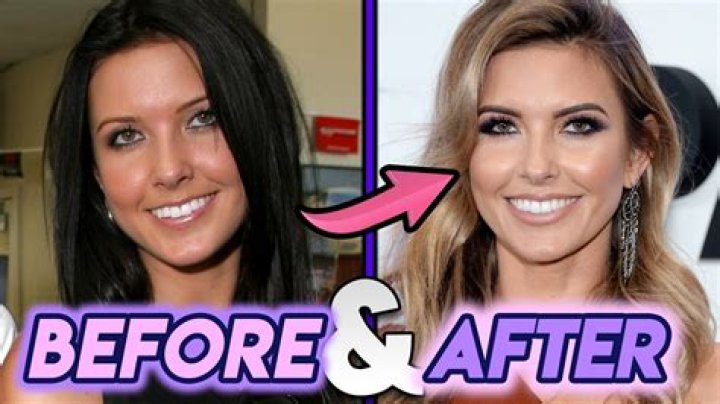 Audrina Patridge Breast Implants Plastic Surgery Before and After
